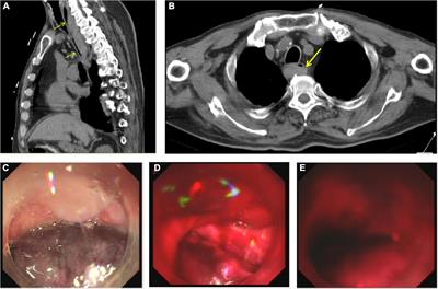 Treatment of Esophageal Hematoma After Left Atrial Appendage Occlusion: A Case Report